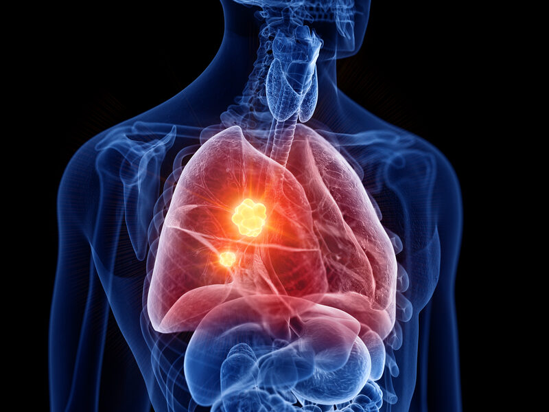non-small cell lung cancer updates