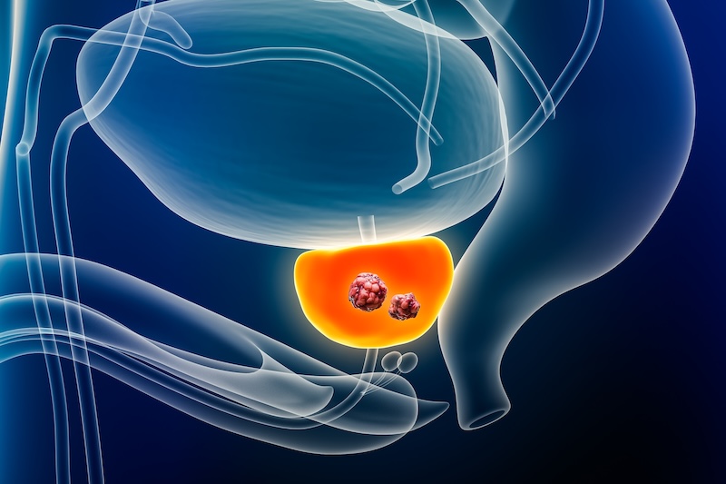 metastatic castration resistant prostate cancer updates