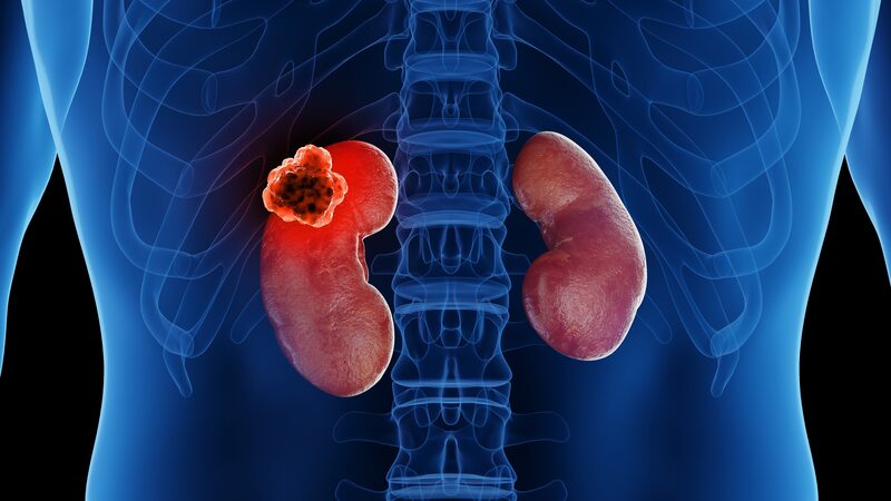 renal cell carcinoma updates
