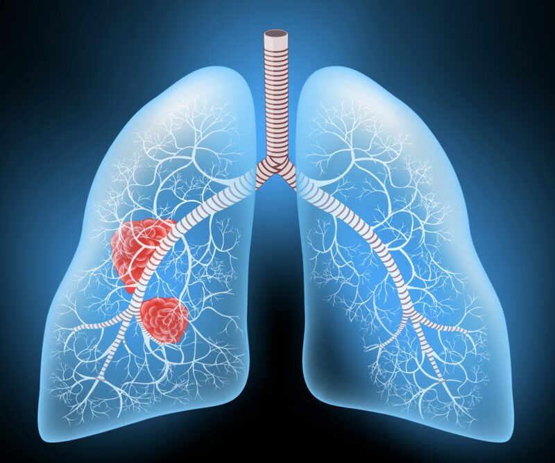 small cell lung cancer updates
